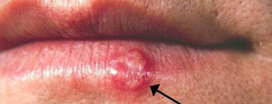 Herpesul oral? Un nou risc asociat acestui virus! Herpesul oral? Un nou risc asociat acestui virus!