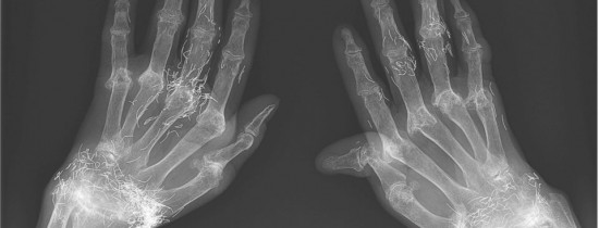 Caz medical bizar: o femeie are încheieturile pline de firicele de aur Caz medical bizar: o femeie are încheieturile pline de firicele de aur