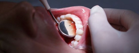 Un nou material dentar poate distruge bacteriile şi împiedică depunerea plăgii Un nou material dentar poate distruge bacteriile şi împiedică depunerea plăgii